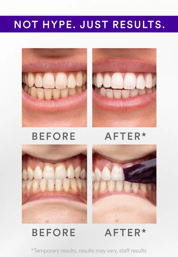 Buy One Get One Free - V34 Whitening Strips