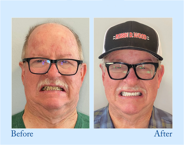 🔥🔥Final 12 Hours: 60%OFF🎁 BBOJI™ Fluoride-Free Hydroxyapatite Toothpaste 💎 Your Smile, Naturally Brighter!(副本)
