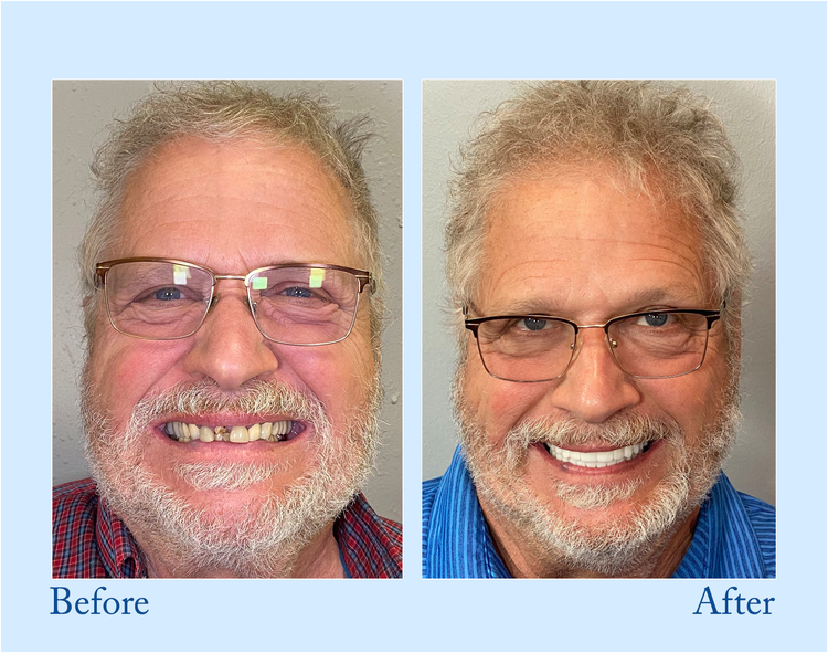 🔥🔥Final 12 Hours: 60%OFF🎁 BBOJI™ Fluoride-Free Hydroxyapatite Toothpaste 💎 Your Smile, Naturally Brighter!(副本)