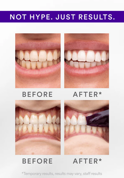 Buy One Get One Free -  V34 Whitening Strips