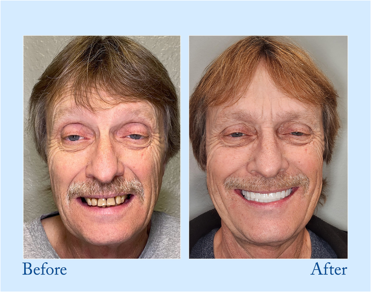 🔥Final 12 Hours: 81%OFF🎁 BBOJI™ Fluoride-Free Hydroxyapatite Toothpaste 💎 Your Smile, Naturally Brighter!