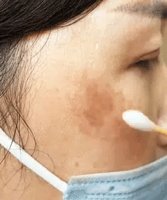 “Dark Spot Eraser for Freckled Skin – Deep Repair Serum That Fights Back Against Years of Sun Damage”